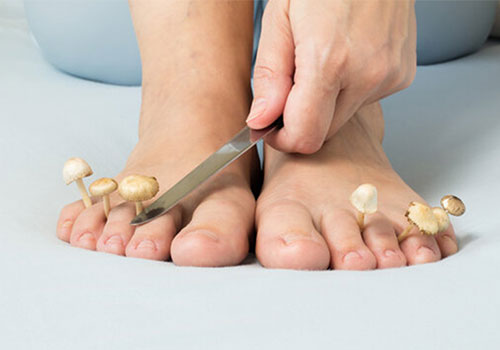 Toenail-Fungal-Infection