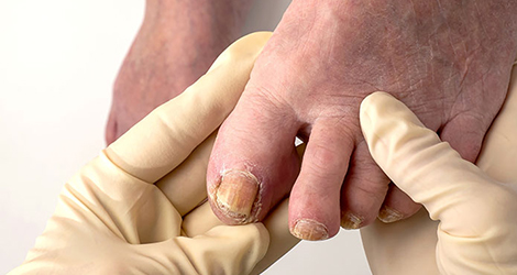 Understanding Involuted Toenails: Causes, Symptoms, and Treatment Options